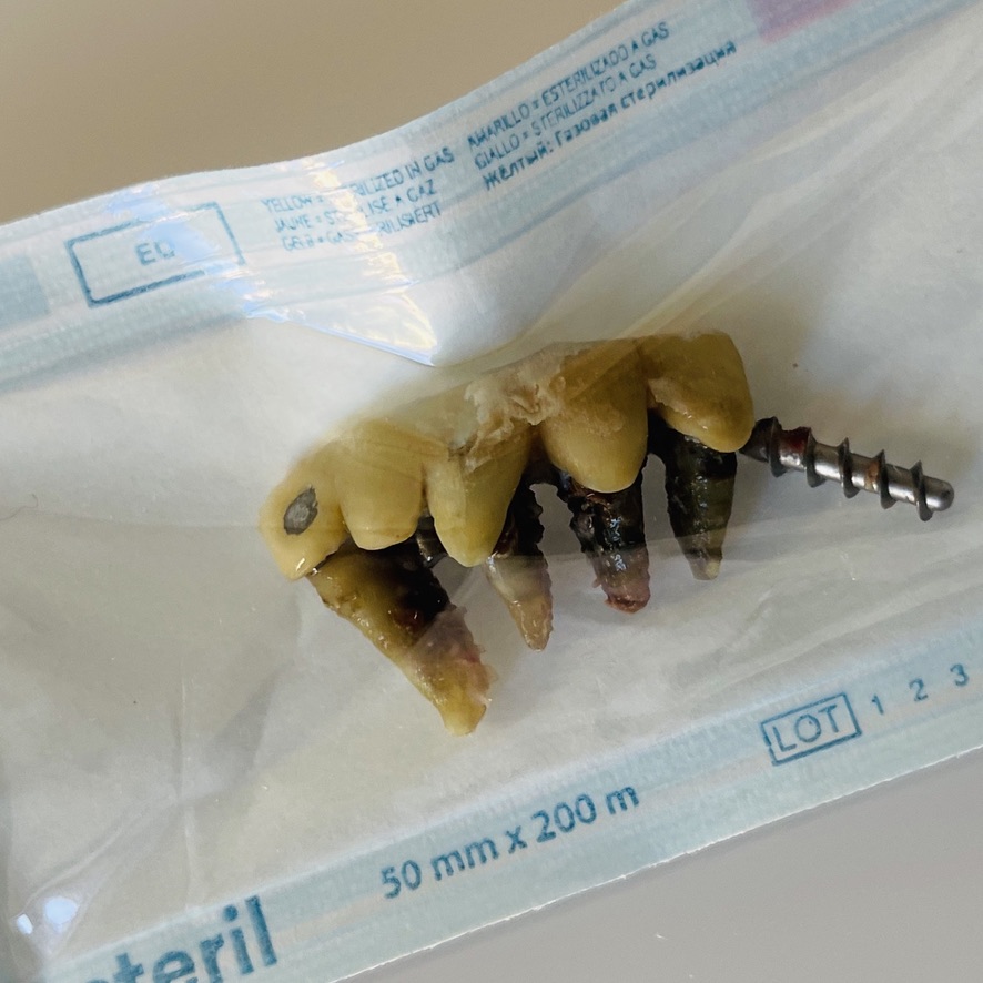 fig2_Important_periodontal disease_of_front_teeth_extracts_in_one_movement.jp