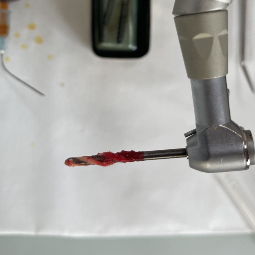 fig6_2 mm twist drill removed bone adhering to the drill.jpeg